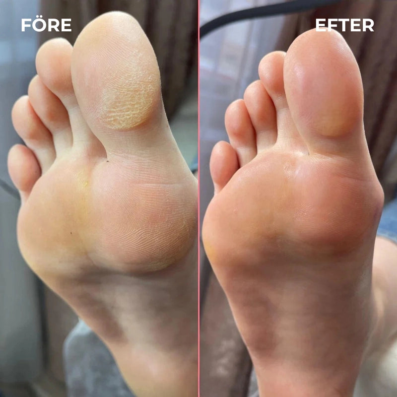 SilkPro™ – Elektrisk Fotslip